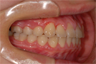 叢生・乱ぐい歯の非抜歯矯正・治療後右側
