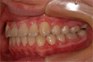 叢生・乱ぐい歯の非抜歯矯正・治療後左側