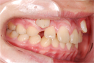 叢生・乱ぐい歯の非抜歯矯正・治療前右側