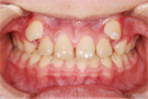 叢生・乱ぐい歯の非抜歯矯正・治療前正面