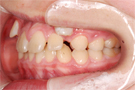 叢生・乱ぐい歯の非抜歯矯正・治療前左側