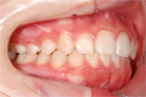 八重歯の非抜歯矯正・治療後右側