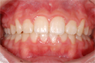 八重歯の非抜歯矯正・治療後正面
