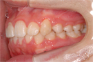 八重歯の非抜歯矯正・治療後左側