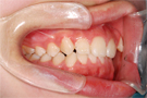 八重歯の非抜歯矯正・治療前右側