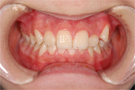 八重歯の非抜歯矯正・治療前正面