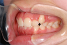 八重歯の非抜歯矯正・治療前左側